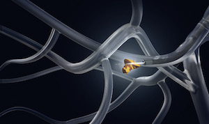 robotic assisted bronchoscopy