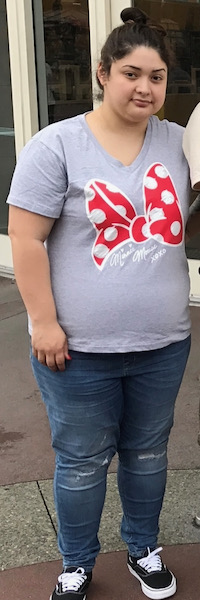 Before image of weight loss surgery