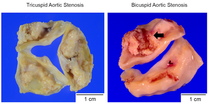 Calcific-Tricuspid-Bicuspid-AS