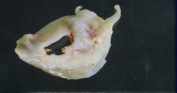 TricuspidBicuspidUnicuspidQuadricuspidValve